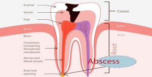 Tooth Abscess