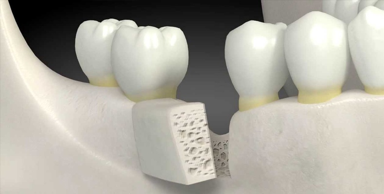 Bone Grafting