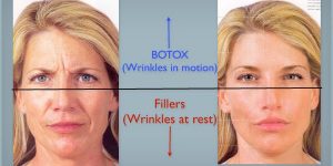 Botox Filler