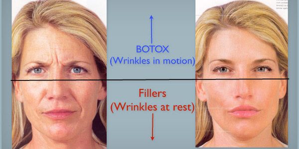 Botox Filler