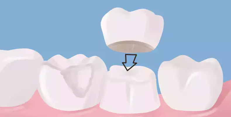 Dental Crowns