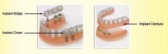 Implant Type