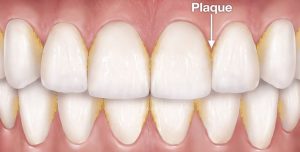 Plaque Buildup