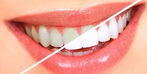 Dental whitening